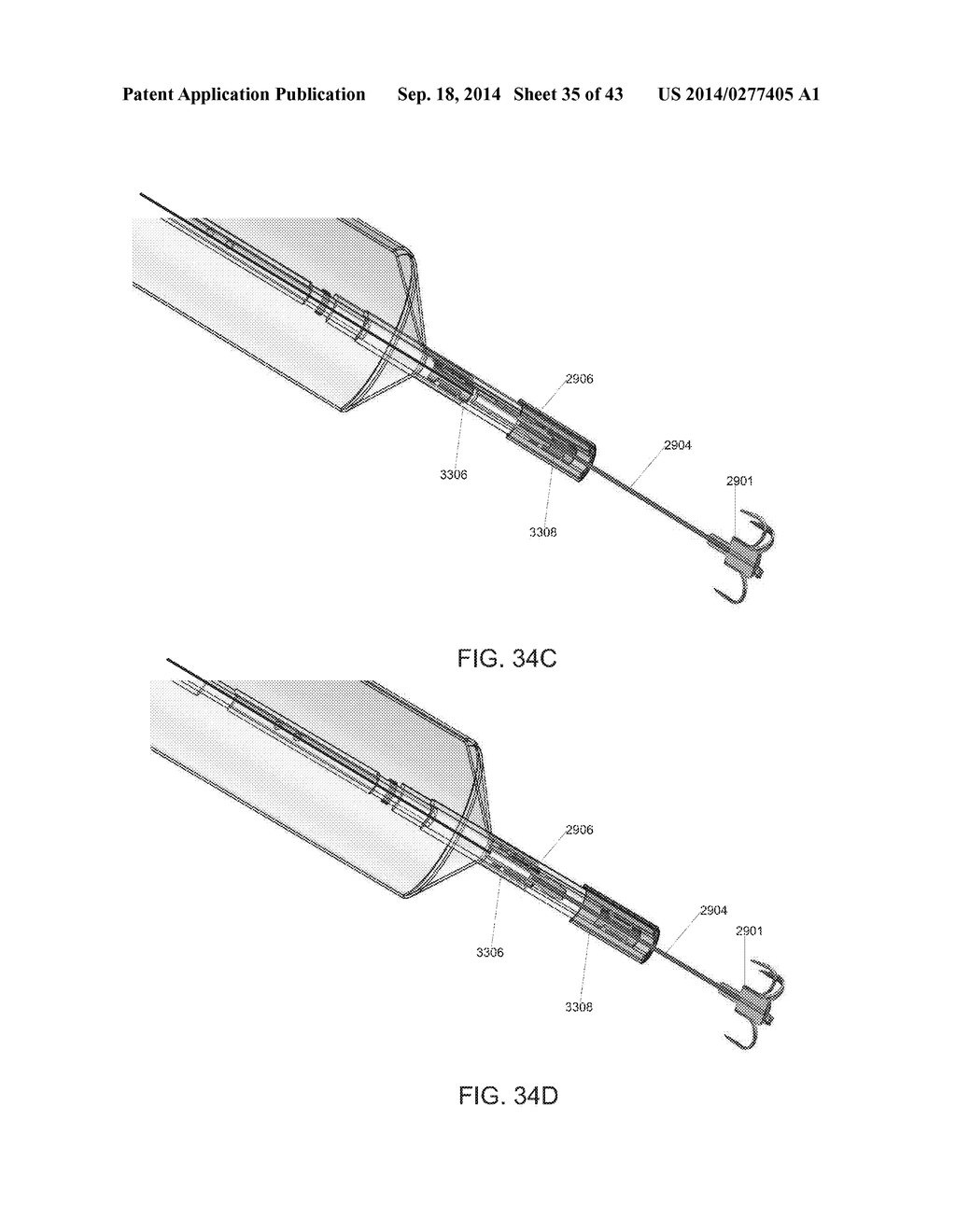 MITRAL VALVE SPACER AND SYSTEM AND METHOD FOR IMPLANTING THE SAME - diagram, schematic, and image 36