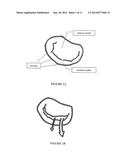 Method and Apparatus for Mitral Valve Annuloplasty diagram and image