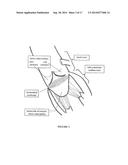 Method and Apparatus for Mitral Valve Annuloplasty diagram and image