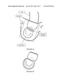 Method and Apparatus for Mitral Valve Annuloplasty diagram and image