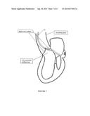 Method and Apparatus for Mitral Valve Annuloplasty diagram and image