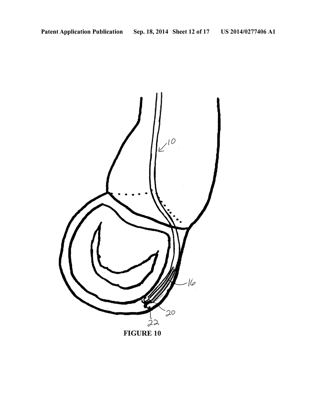 Method and Apparatus for Mitral Valve Annuloplasty - diagram, schematic, and image 13