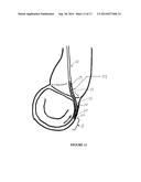 Method and Apparatus for Mitral Valve Annuloplasty diagram and image