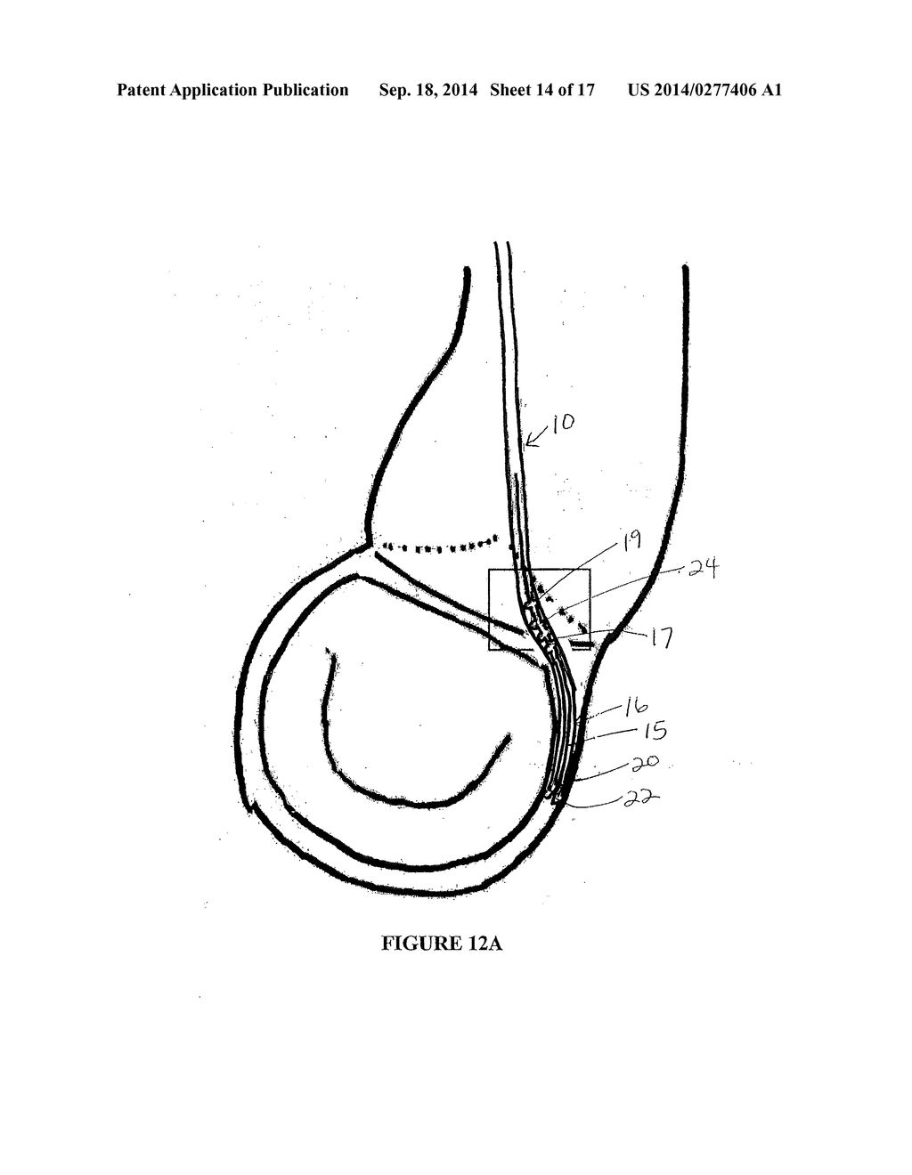 Method and Apparatus for Mitral Valve Annuloplasty - diagram, schematic, and image 15