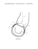 Method and Apparatus for Mitral Valve Annuloplasty diagram and image