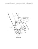 Method and Apparatus for Mitral Valve Annuloplasty diagram and image