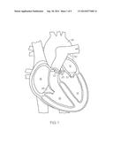 Prosthetic Heart Valve System diagram and image