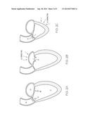 Prosthetic Heart Valve System diagram and image