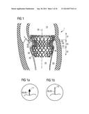 TRANSCATHETER VALVE PROSTHESIS diagram and image