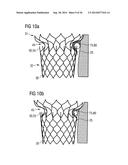 TRANSCATHETER VALVE PROSTHESIS diagram and image