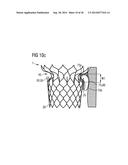 TRANSCATHETER VALVE PROSTHESIS diagram and image