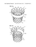 TRANSCATHETER VALVE PROSTHESIS diagram and image