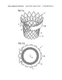 TRANSCATHETER VALVE PROSTHESIS diagram and image