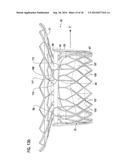 TRANSCATHETER VALVE PROSTHESIS diagram and image