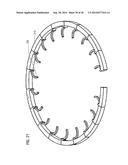 TRANSCATHETER VALVE PROSTHESIS diagram and image