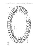 TRANSCATHETER VALVE PROSTHESIS diagram and image