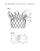 TRANSCATHETER VALVE PROSTHESIS diagram and image