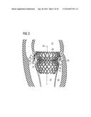 TRANSCATHETER VALVE PROSTHESIS diagram and image