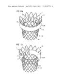 TRANSCATHETER VALVE PROSTHESIS diagram and image