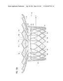 TRANSCATHETER VALVE PROSTHESIS diagram and image