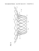 TRANSCATHETER VALVE PROSTHESIS diagram and image