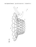 TRANSCATHETER VALVE PROSTHESIS diagram and image