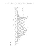 TRANSCATHETER VALVE PROSTHESIS diagram and image