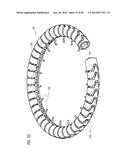 TRANSCATHETER VALVE PROSTHESIS diagram and image