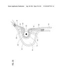 TRANSCATHETER VALVE PROSTHESIS diagram and image