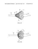 Anti-Paravalvular Leakage Component for a Transcatheter Valve Prosthesis diagram and image