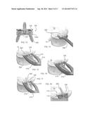 Expandable Intervertebral Implant diagram and image