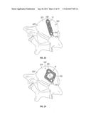 Expandable Interbody Spacer diagram and image