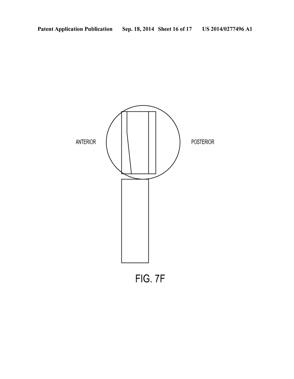 EXPANDABLE DEVICE FOR IMPLANTATION IN BODY SPACE - diagram, schematic, and image 17