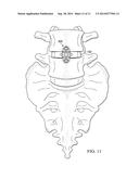 Bone Fusion Implant Device diagram and image