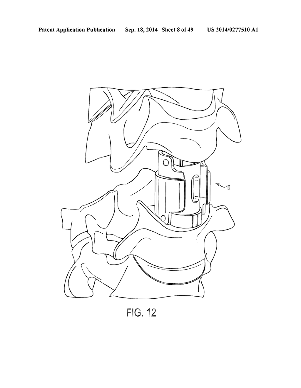 EXPANDABLE VERTEBRAL BODY REPLACEMENT DEVICE, SYSTEM, AND METHODS - diagram, schematic, and image 09