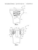 SYSTEMS AND METHODS FOR JOINT REPAIR INCLUDING SUBCHONDRAL TREATMENT OF     BONE diagram and image