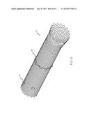 STENT HAVING REMOVABLE ANCHORING ELEMENT diagram and image