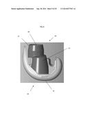 VOID FILLING JOINT PROSTHESIS AND ASSOCIATED INSTRUMENTS diagram and image