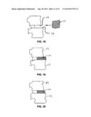 BONE GROWTH PROMOTION SYSTEMS AND METHODS diagram and image