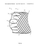 ESOPHAGEAL STENT diagram and image