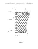 ESOPHAGEAL STENT diagram and image