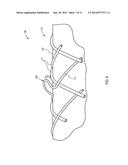 ESOPHAGEAL STENT diagram and image