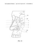 INTERFACE COMPRISING A NASAL SEALING PORTION diagram and image