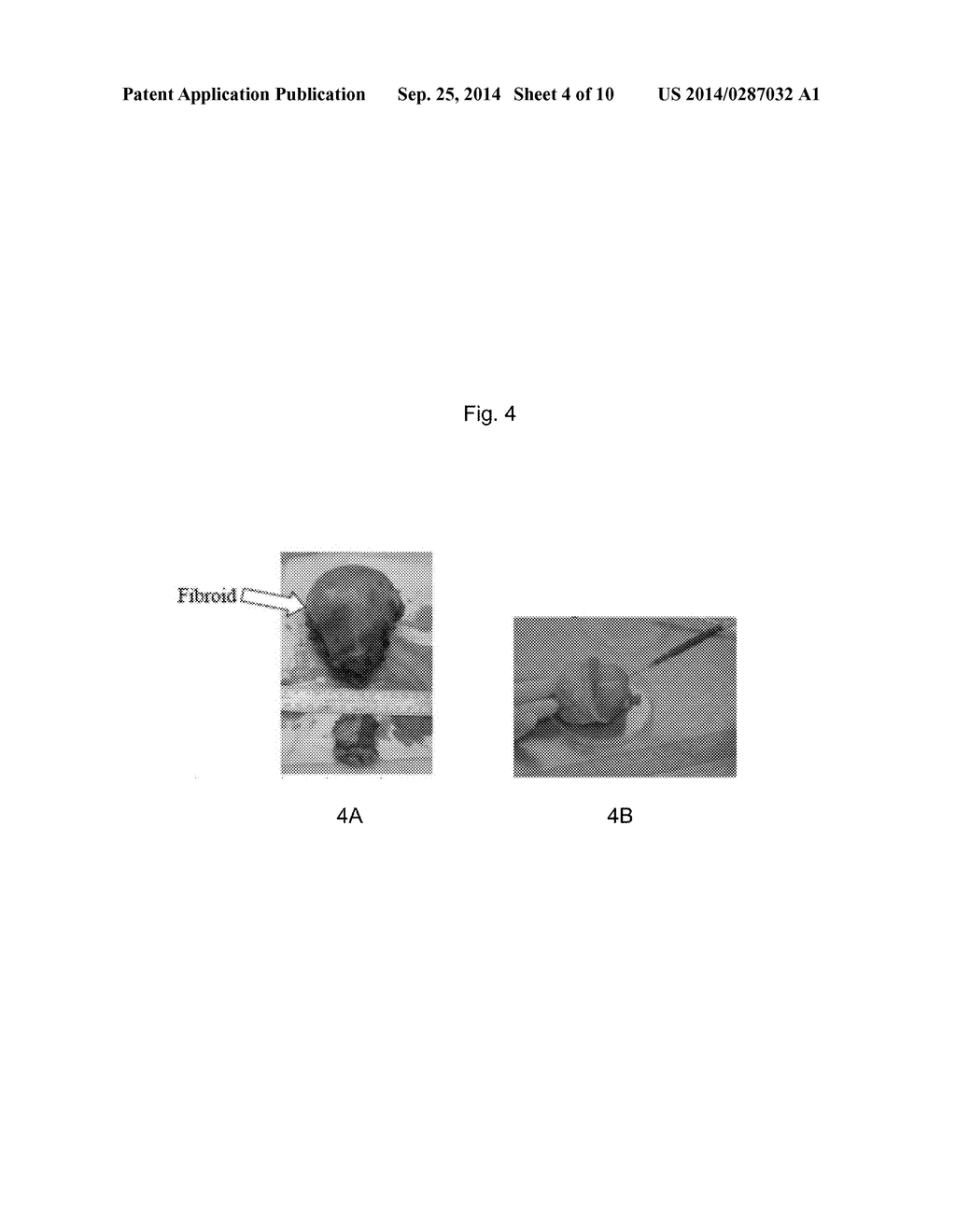 Treatment Method and Product for Uterine Fibroids using Purified     Collagenase - diagram, schematic, and image 05