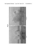 Treatment Method and Product for Uterine Fibroids using Purified     Collagenase diagram and image