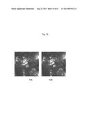 Treatment Method and Product for Uterine Fibroids using Purified     Collagenase diagram and image