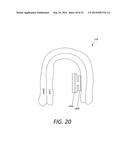 ORTHODONTIC BRACKET PLACEMENT USING BRACKET GUIDE FEATURES diagram and image