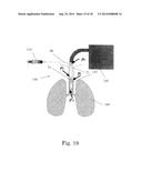 PRESSURE REGULATING SYRINGE AND METHOD THEREFOR diagram and image