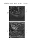 UV IMAGING FOR INTRAOPERATIVE TUMOR DELINEATION diagram and image