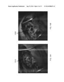 UV IMAGING FOR INTRAOPERATIVE TUMOR DELINEATION diagram and image